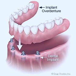 An Implant-Supported Denture Offers a Number of Advantages